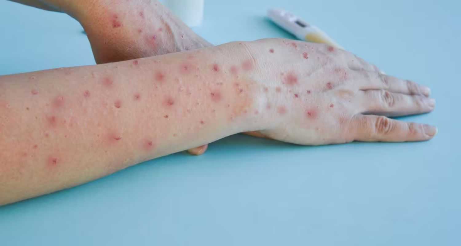 India Alerts Airports Ports Over Rising Mpox Threat.