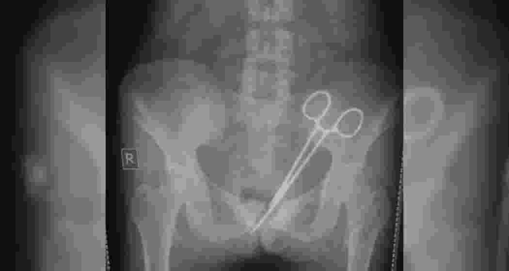 An X-ray reveals the surgical forceps left inside the patient’s abdomen.