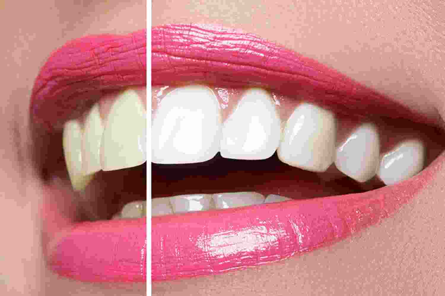 Perfect smile? Beware the risks of cheap dentistry