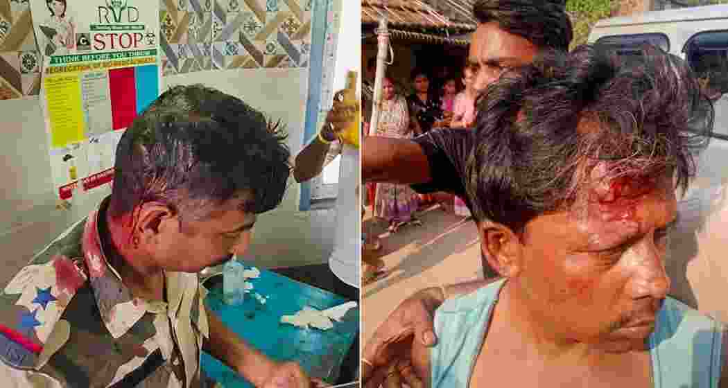 Bardhman: In this combo image, BJP candidate Dilip Ghosh's personal security (left) and a TMC worker (right), got injured after alleged clashes broke out between supporters of TMC and BJP in Monteswar's Susunia area of Bardhaman-Durgapur Lok Sabha seat around noon, as BJP candidate Dilip Ghosh was on his way to a polling booth following complaints of booth jamming, during the fourth phase of Lok Sabha elections, in Bardhman, Monday, May 13, 2024. 