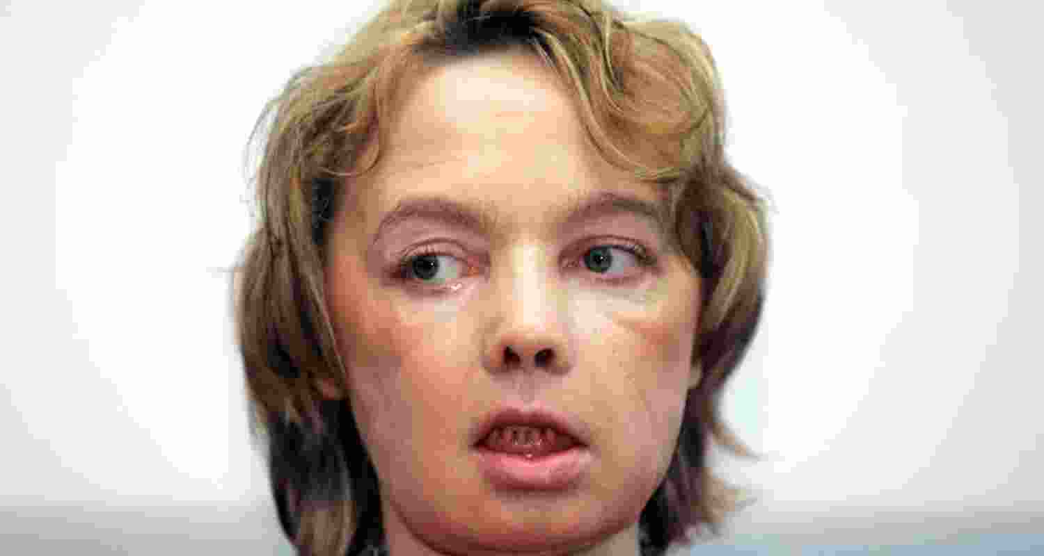 Face transplants: 20 years on, key questions remain