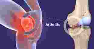 Chinese scientists claim to have developed hydrogel for Arthritis: Report