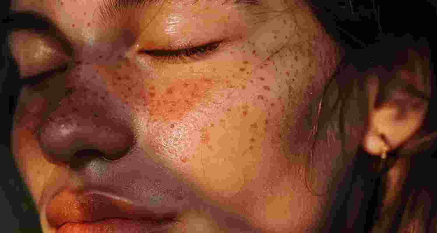 TikTok 'sunburning' trend may cause cancer, not acne relief