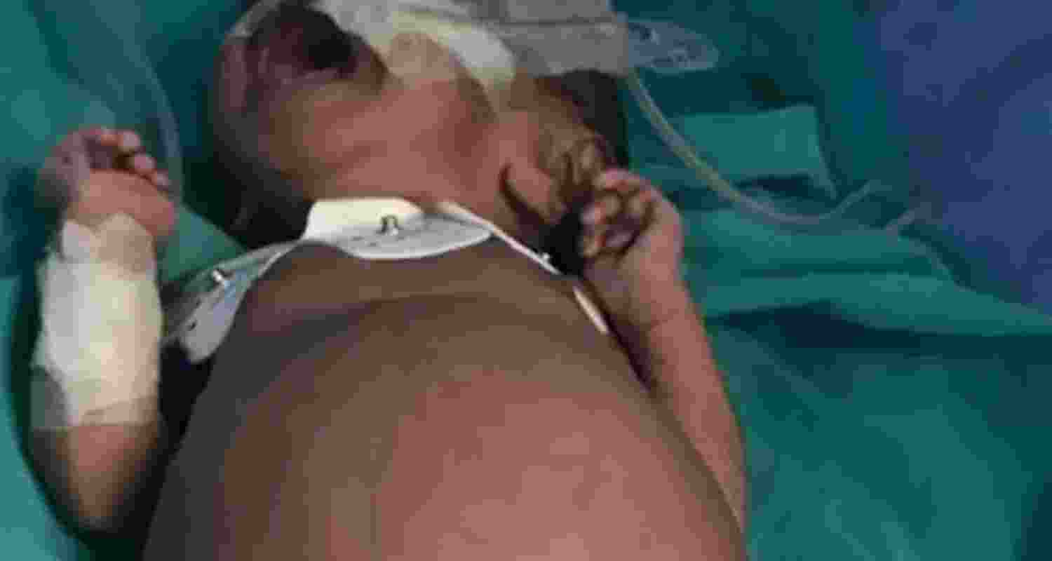 Fetus inside: Baby born with rare medical condition in K'taka