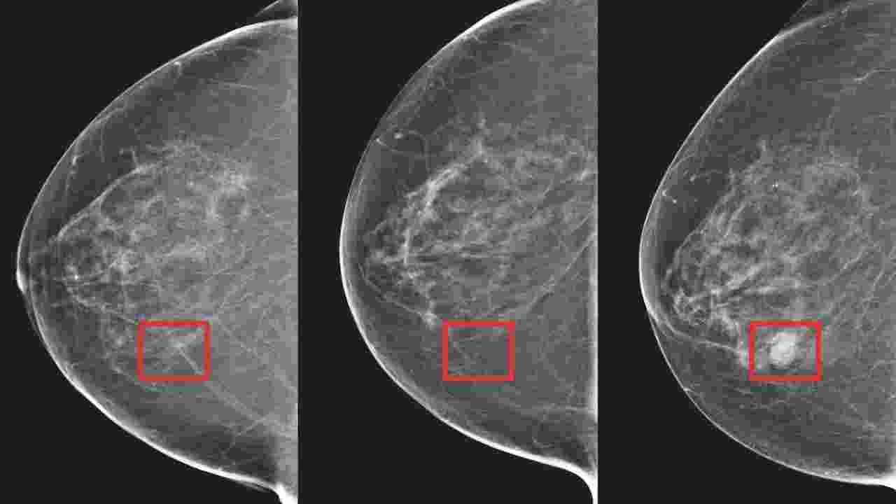 Artificial intelligence detects breast cancer 5 years before it develops. Image: X