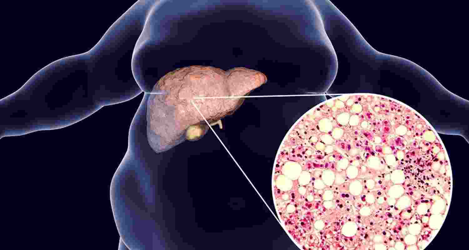 HP launches awareness drive on non-alcoholic fatty liver