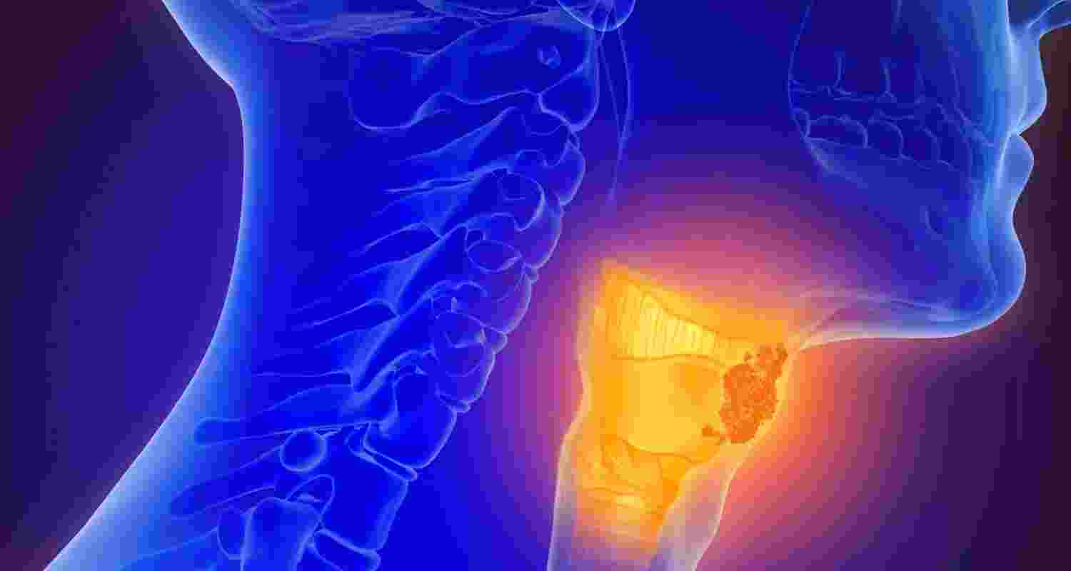 Oral sex now top risk factor for throat cancer rise