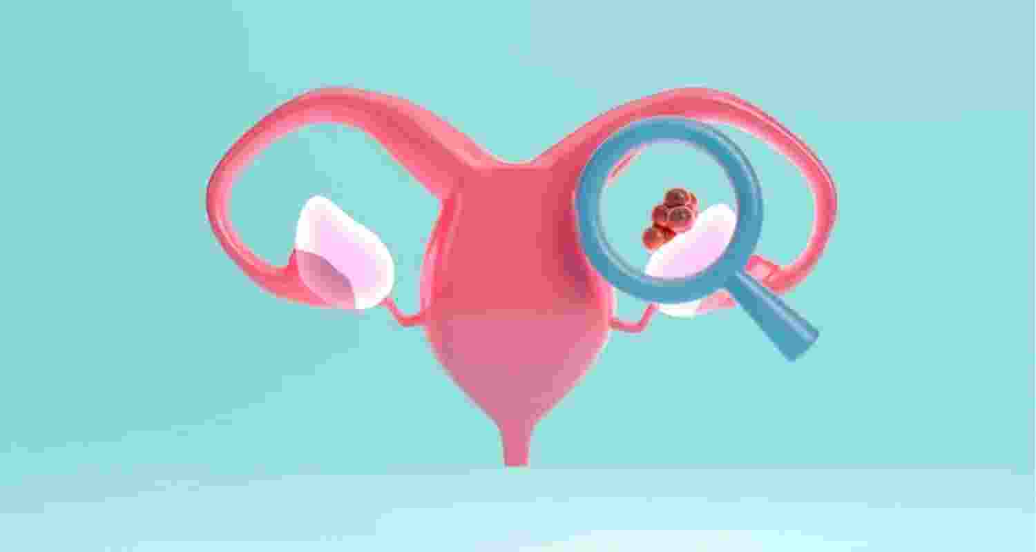 New drug to prolong lives of ovarian cancer patients