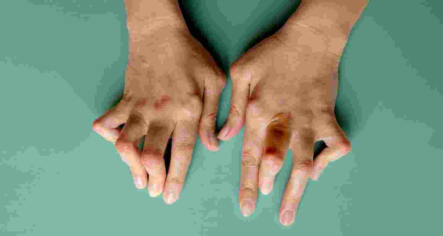 Gut microbiome changes linked to arthritis symptoms