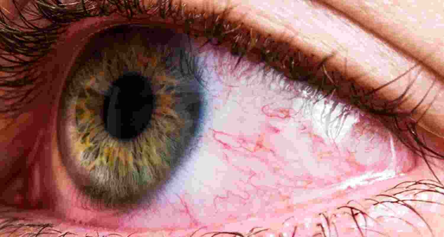 Eye Allergies. Image For Representative Use Only. Eye Allergies. Image For Representative Use Only.