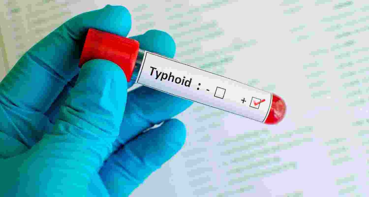 Telangana accounts for India's one in every five Typhoid deaths Telangana accounts for India's one in every five Typhoid deaths