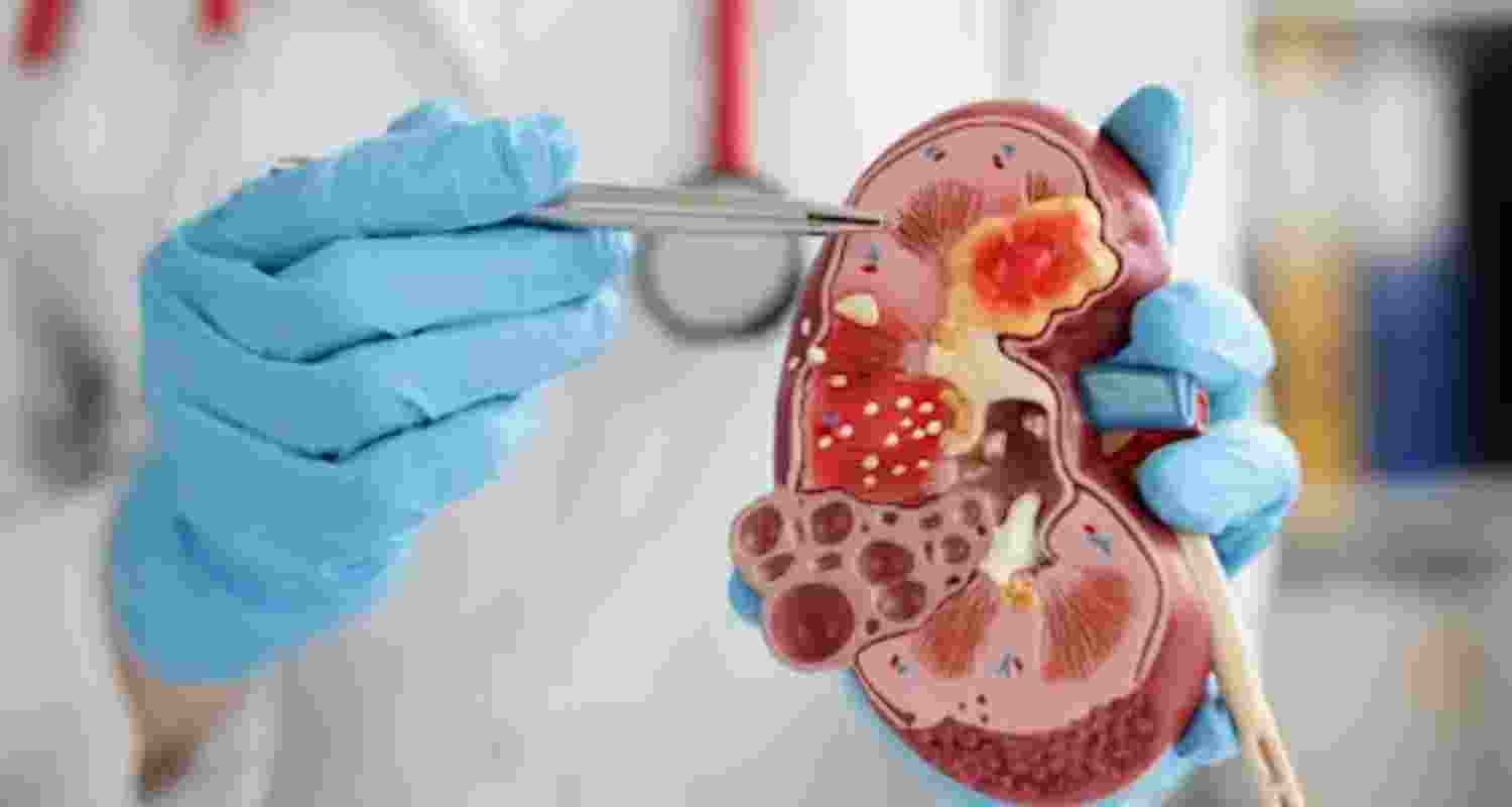 Telangana reports highest kidney disease mortality rate Telangana reports highest kidney disease mortality rate